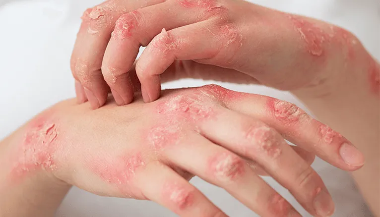 Practical steps you can take to manage discoid eczema symptoms