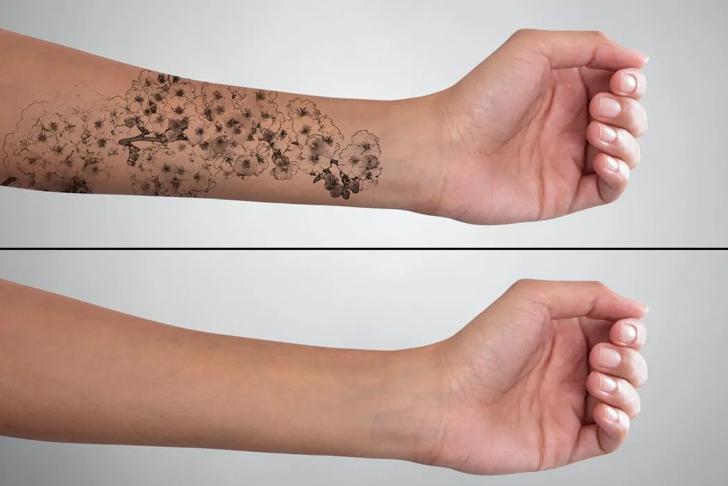 There are some risks associated with tattoo removal, including