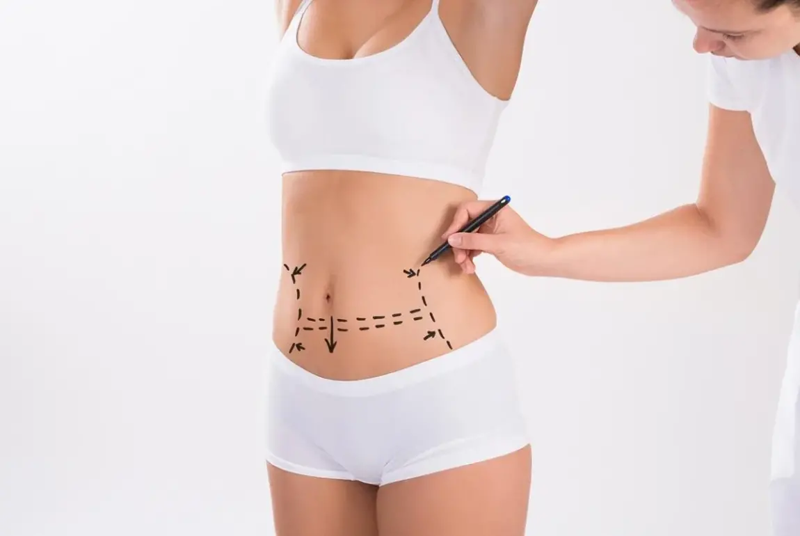 What is involved in liposuction?