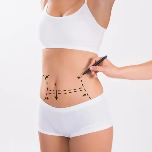 What is involved in liposuction?