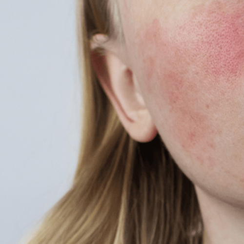 The reasons your face turns red