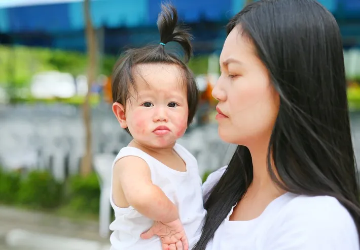 Uncertainty About Slapped Cheek Syndrome